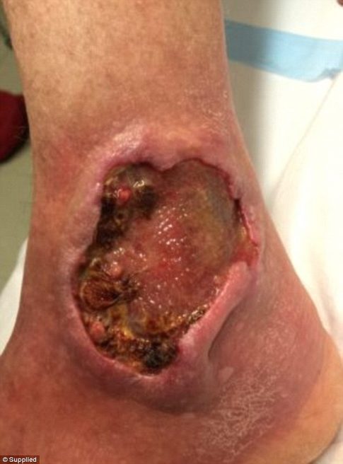 Mysterious flesh eating bug that cause gangrenous open wounds spreads in Australia - and doctors have no idea what causes it