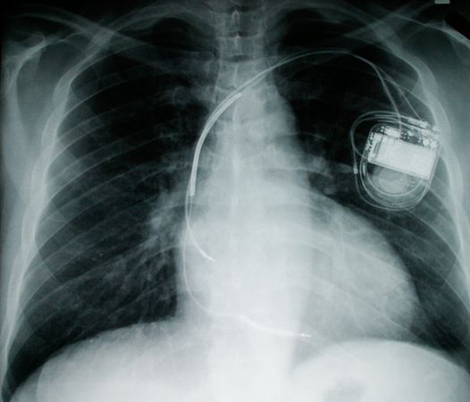 mice-fuel-cells-implants-pacemaker