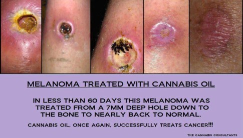 Melanoma Cannabis Oil